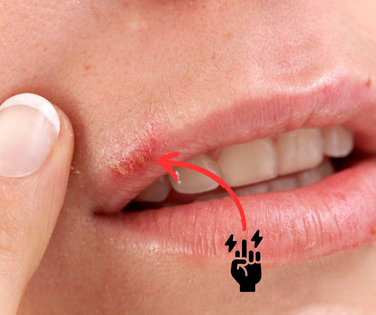 Behandla munsår naturligt med Rödljusterapi